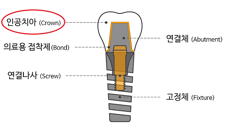 임플란트 빠짐 / 임플란트 보철 빠짐 / 임플란트 크라운 재부착