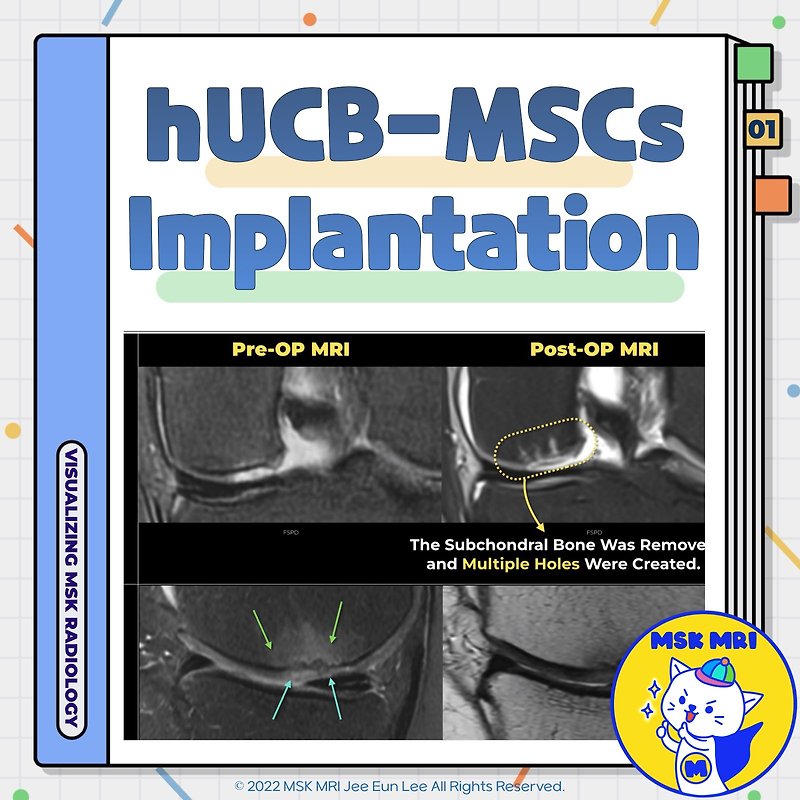 (Fig 5-C.01) MRI Findings of hUCB-MSCs Implantation
