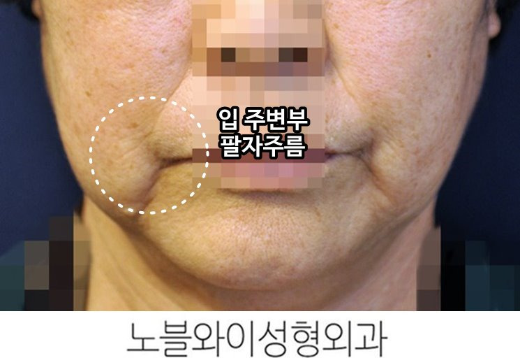 팔자주름성형비용 결정 이유는 10년 유지때문?