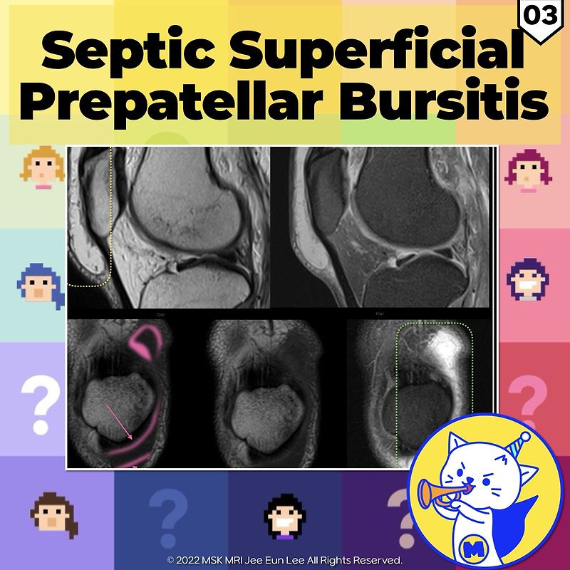 (fig 4-d.03) Septic Prepatellar Bursitis