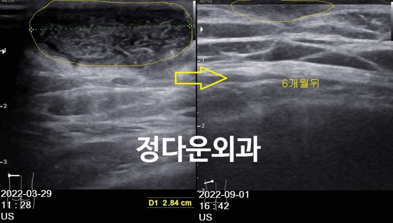 정다운 외과 별전 :: [동작구 관악구 표피낭종 지방종] 정다운외과 - 지방종이나 피지낭종이 생기는 원인은 무엇일까요?