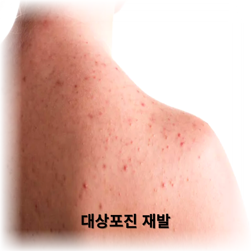대상포진의 숨겨진 위험! 대상포진 재발