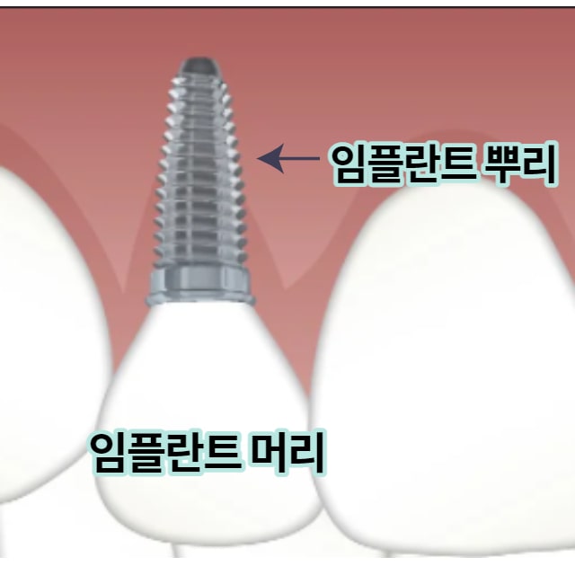 임플란트 수명, 임플란트 수명 다하면