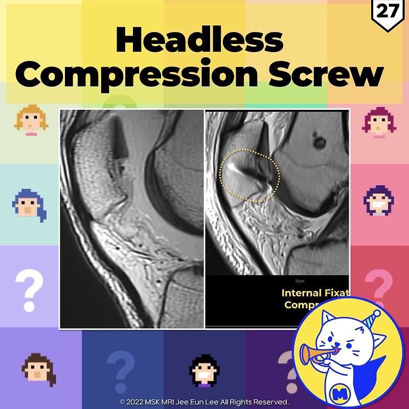 (Fig 4-A.27) Headless Compression Screw Fixation of Osteochondral Fracture