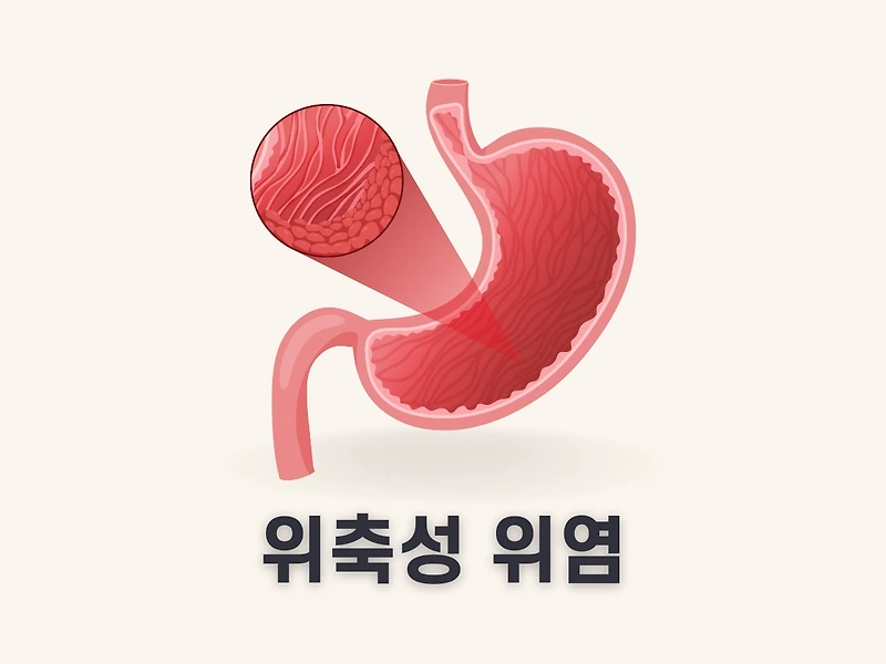 위축성 위염 증상 원인 치료 방법