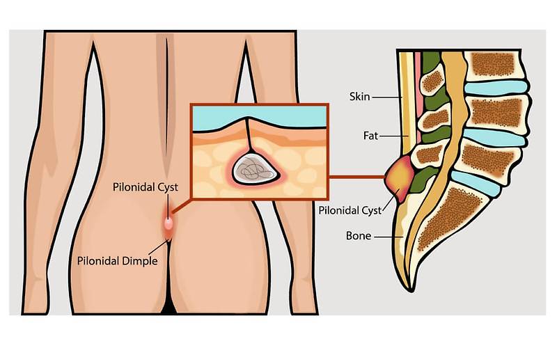 꼬리뼈에 난 종기 모소낭 모소동 수술 후기