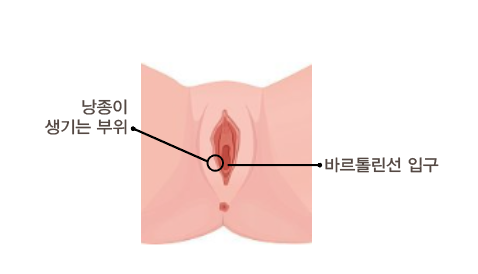 여성 사타구니 종기 '바르톨린 낭종'이 생겼다면?