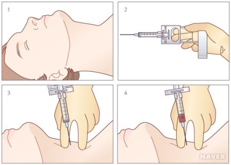 갑상선 조직검사후기- 미세침흡인 세포검사(세침 검사)