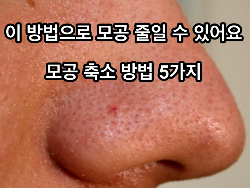 큰 모공의 원인인 모공축소법!