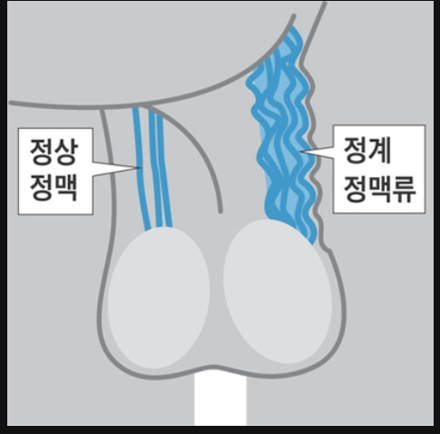 정계정맥류 수술 후기 1.