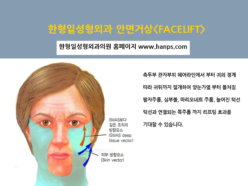 안면거상수술 잘하는병원 한형일성형외과