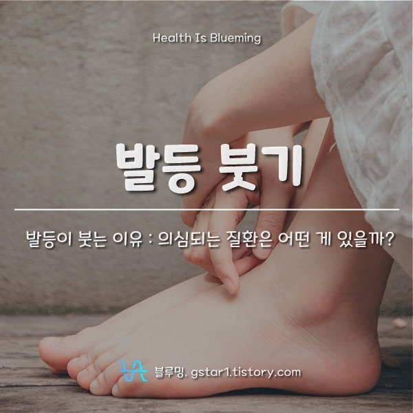 Top 8 한쪽 발등 이 붓는 이유 Best 243 Answer