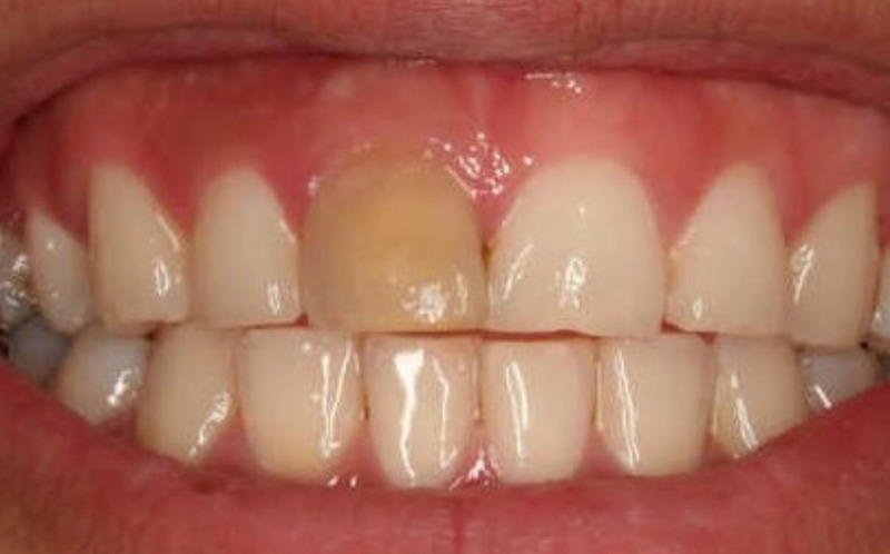 죽은 치아의 신호와 대처 (신경치료를 해야하는 이유)