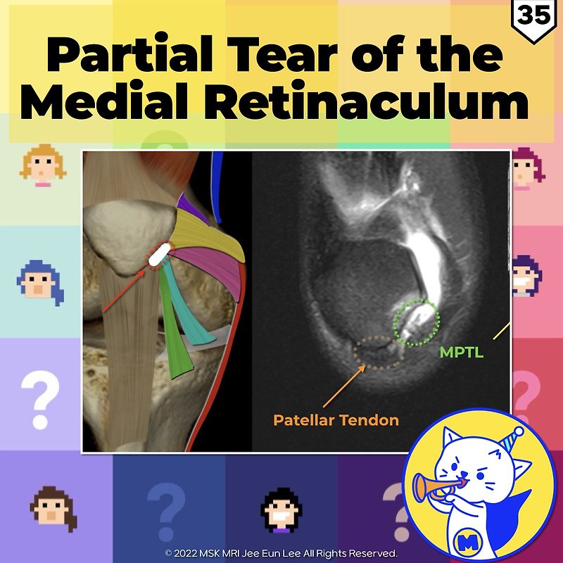 (Fig 4-A.35) Partial Tear of the Medial Retinaculum