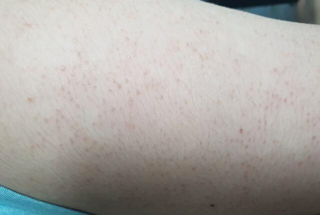 모공각화증 로션 피부 오돌토돌 가려움