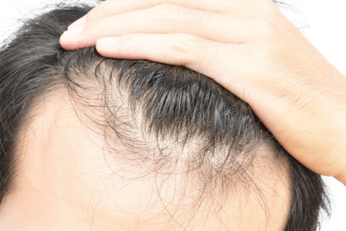 머리카락에좋은음식 꼭먹어요 10