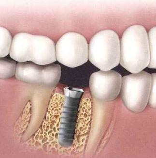골이식 임플란트 비용에 대해 알아봅시다. 8