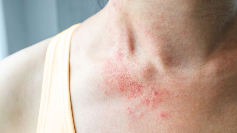 섭식 장애와 아토피 피부염의 연관성