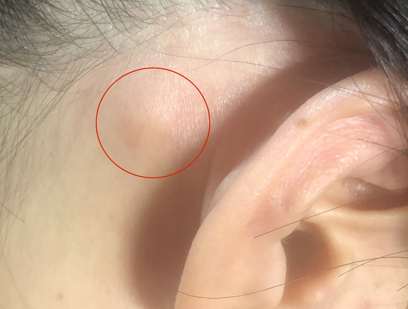 목이나 귀 뒤에 생기는 멍울, 임파선염(Lymphadenitis)이란?