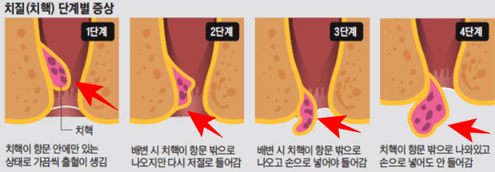 치질 수술 후회 및 비용 회복기간 실제 후기