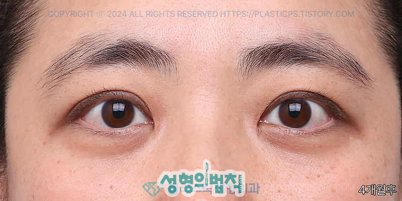 결코 늦지 않은 쌍꺼풀 수술, 더 또렷해진 눈꺼풀 이야기