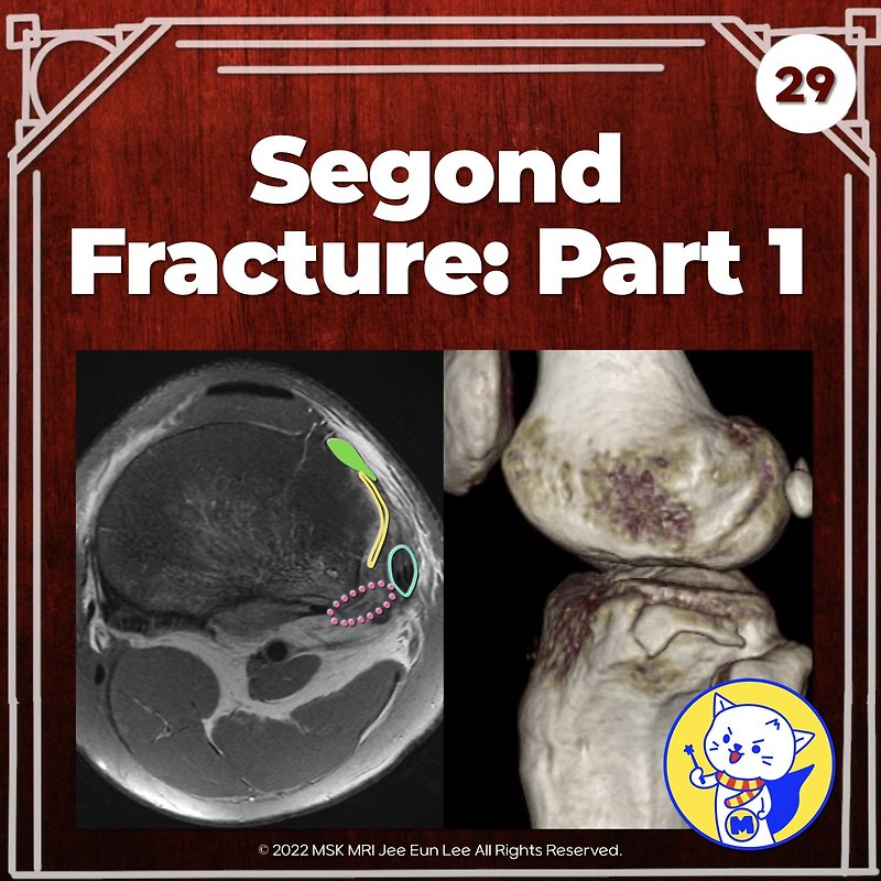 (Fig 3-B.29) Segond Fracture