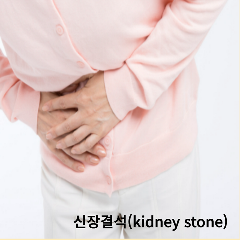 신장결석 통증 위치, 요로결석 자연배출 운동