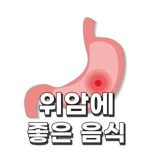 위암에 대해 알아보자! 위암 치료방법, 좋은 음식, 운동은?