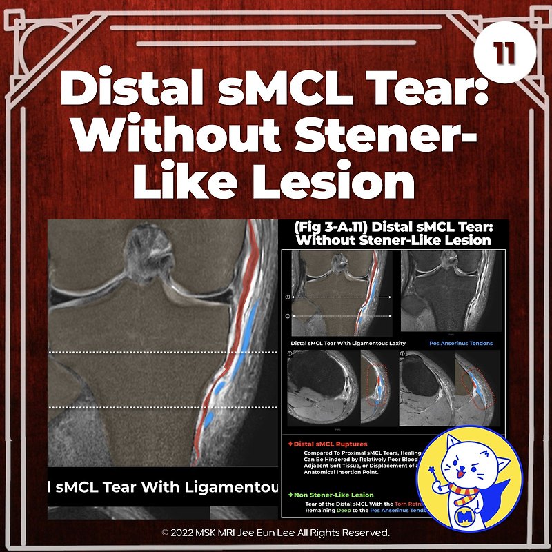 (Fig 3-A.11) Distal sMCL Tear: without Stener-Like Lesion