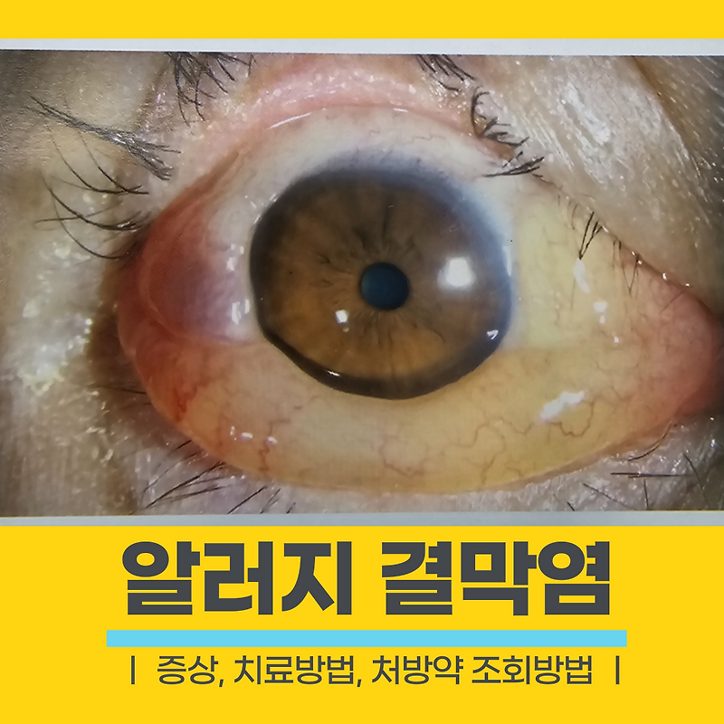 알러지 결막염 증상, 사진 참고, 알레르기 결막염