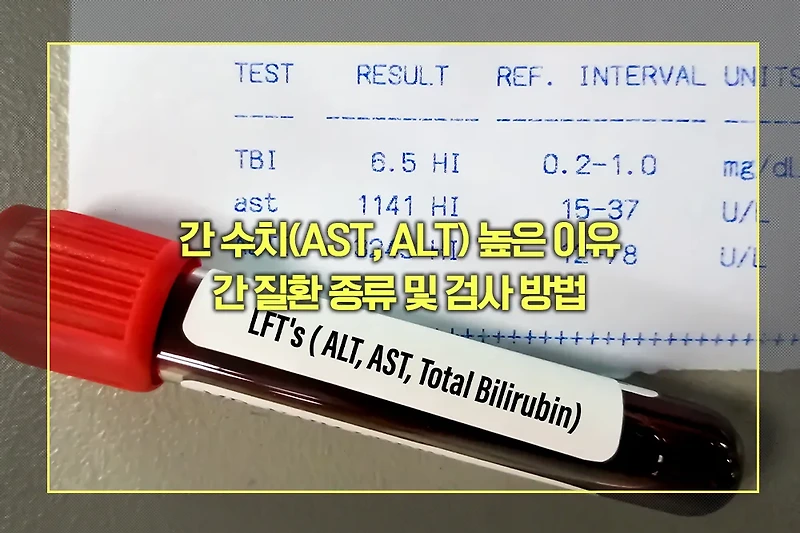 간 수치(AST, ALT) 높은 이유, 간 질환 종류 및 검사 방법
