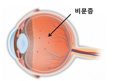 비문증 치료방법 원인 자연치유 / 치료약 및 증상