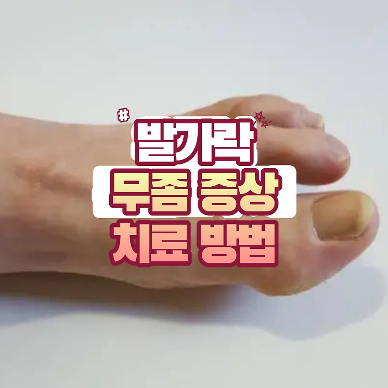 발가락 무좀 증상 및 치료 방법