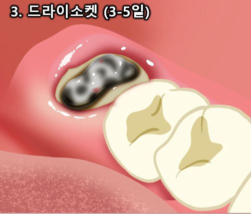 드라이 소켓, 사랑니 발치후 붓기 등 사랑니 발치 후 이상증상 완벽정리