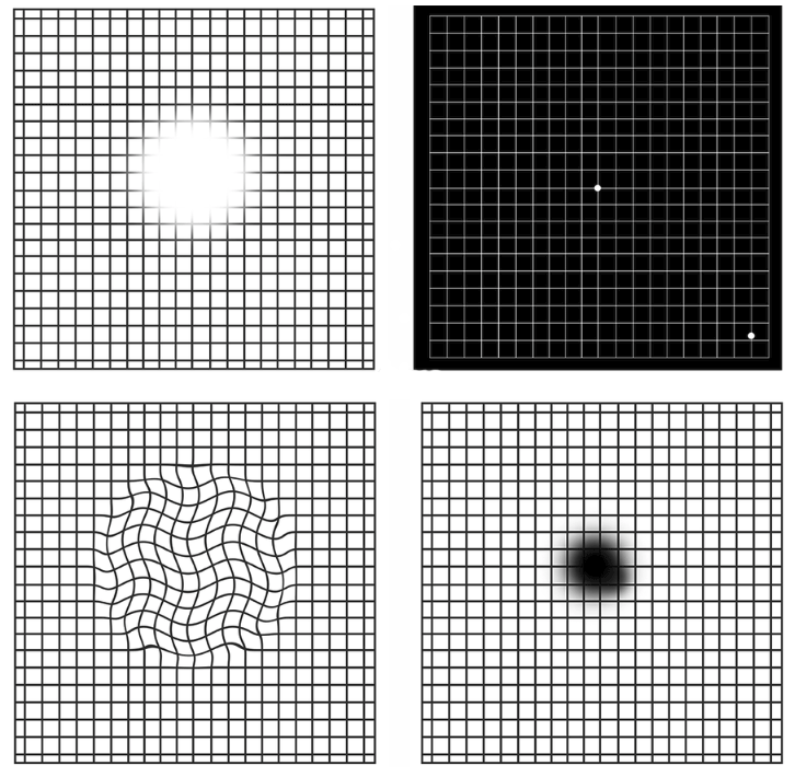 황반변성 증상 자가진단 암슬러 격자테스트 알아보자