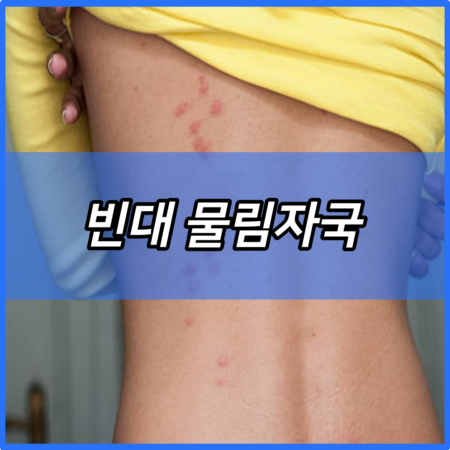빈대 물림자국 및 신고 방법 (서울시 감염병 연구센터 누리집) | 퇴치제 살충제 | 물리면 증상 | 예방법 | 관련 주식 찾기 | 세스코 방역 가정집 비용 2024