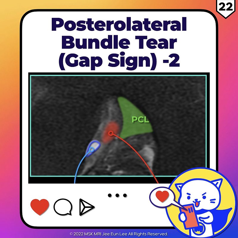 (Fig 2-B.22) Posterolateral bundle tear (Gap sign) -2