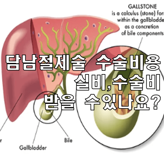 A형간염 입원, 증상, 입원비, 치료과정, 보건소비 지원 신청