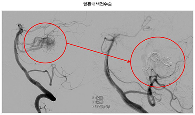 뇌 동정맥 기형 뇌출혈 원인 수술 치료비지원