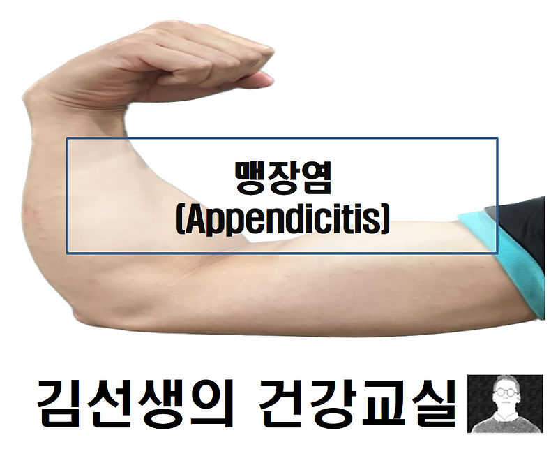 맹장염(Appendicitis)