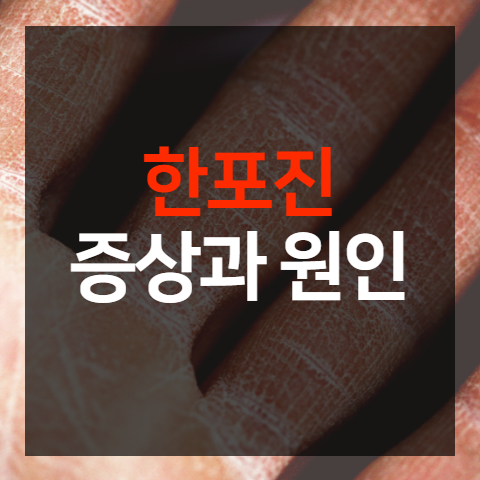 한포진 - 손가락, 발가락 원인과 증상, 대상포진과 차이점