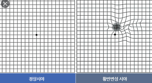 황반변성 수술비용