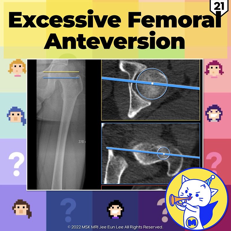 (Fig 4-A.21) Excessive Femoral Anteversion