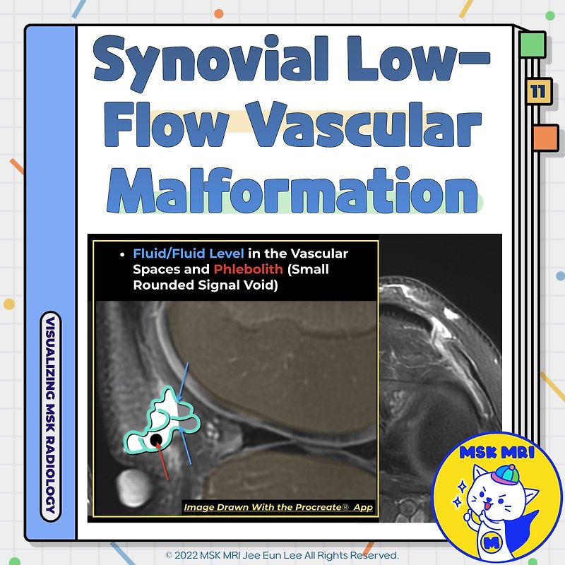 (Fig 5-E.11) Synovial Low-Flow Vascular Malformation (Synovial Hemangioma)