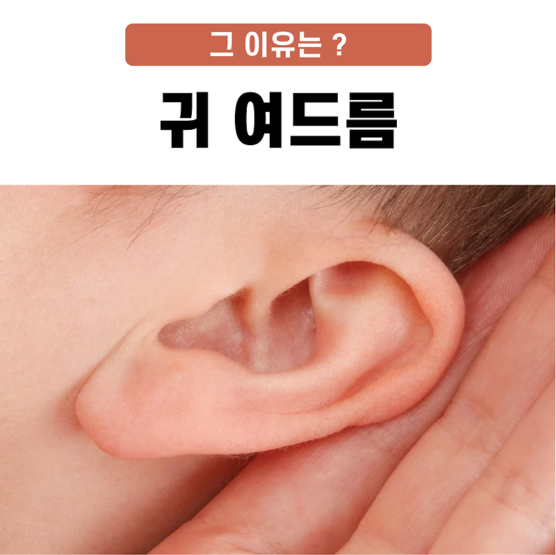 귀 여드름 그 이유는?