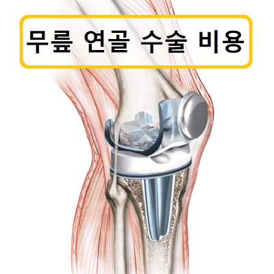 무릎 연골 수술 및 수술 후 재활 비용을 잊지 마세요