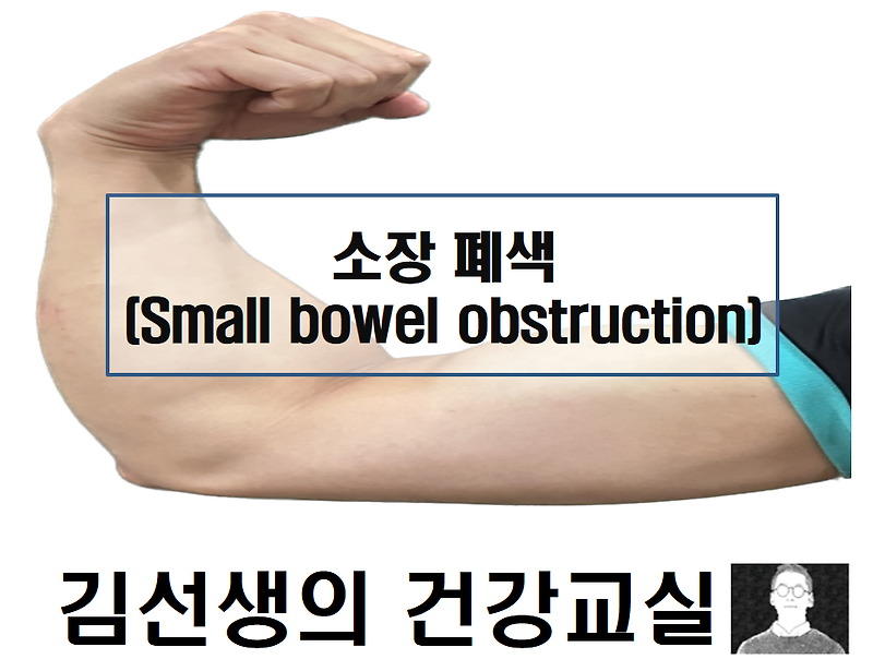 소장 폐색(Small bowel obstruction)