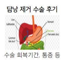 담낭 제거 수술 후기④ : 수술 회복기간, 통증, 후유증 등 관련 정리