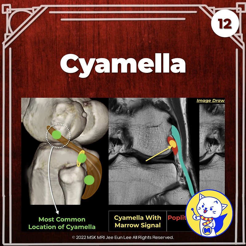 (Fig 3-B.12) Cyamella vs Fabella