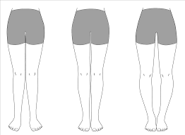 O자 다리 : 오다리, O다리 교정, O다리 원인, O다리 다리근육